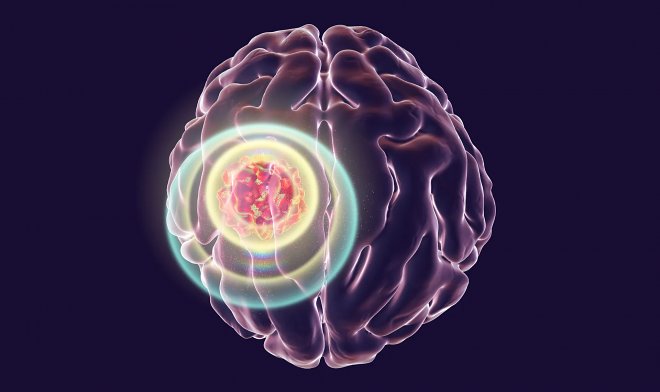 Инфракрасный имплант в черепе показал эффективность в борьбе с раком мозга 