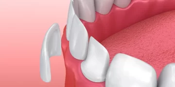 Ультраниры: что это такое и для чего они используются?