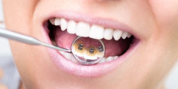 Внутренние брекеты: показания к установке