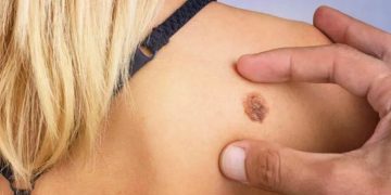 Лечение меланомы и рака кожи: современные методы