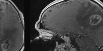 Особая диета запускает в раковых клетках механизм самоуничтожения