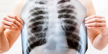 В «Сколтехе» обучили нейросеть обрабатывать рентген-снимки легких и ставить диагноз