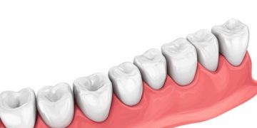 Наращивание зубов со штифтом: инновационная процедура для восстановления зубного ряда без боли
