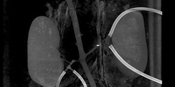 Миллироботы смогут разрушать тромбы и пробивать себе путь через кровеносные сосуды