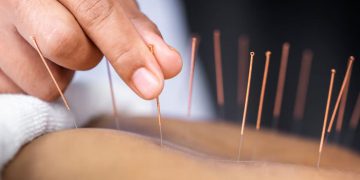 Иглоукалывание доказало эффективность в восстановлении после инсульта