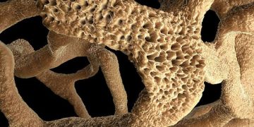 Российско-иранский препарат эффективно вылечит остеопороз