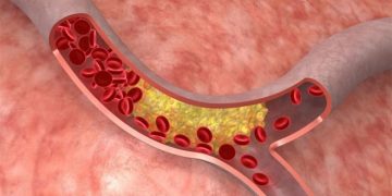 В Новосибирске создан полимер, предотвращающий разрывы сосудов