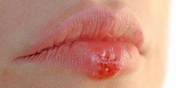 Заражение герпесом вдвое увеличивает риск появления деменции