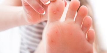 Бородавки на стопах: почему они возвращаются и как их победить навсегда