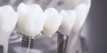 Имплантация зубов: все, что нужно знать