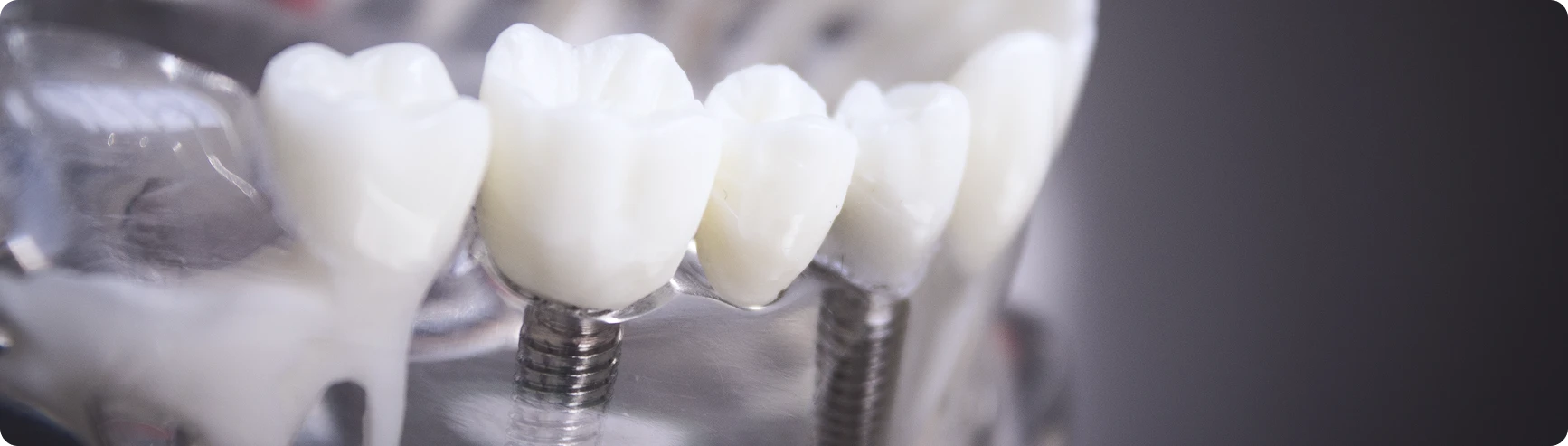 Имплантация зубов: все, что нужно знать
